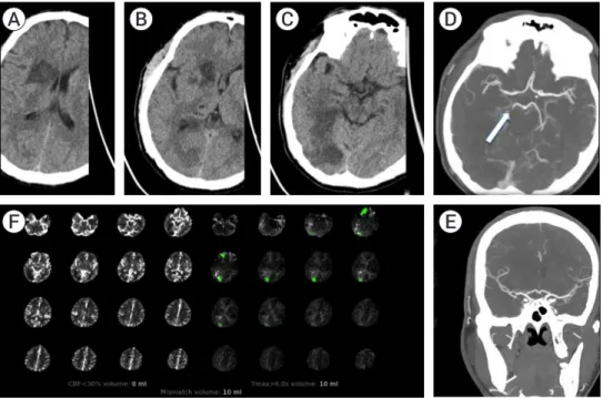 Fig. 3. Demonstration of core infarct discrepancy in patient 6. Axial non-contrast computed tomography (CT) head images (A, B, C) show  clear hypodensity in the right periventricular area, basal ganglia and occipital lobe