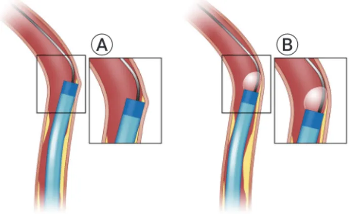 Fig. 4. The razor-like effect (A) caused by catheter apposition  to vessel wall can be alleviated with the use of balloon-assisted  tracking (B)