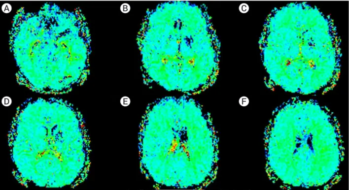 Fig. 5. The AP (A) and lateral views (B, C) of the control angiogram obtained at 6 months demonstrating stent patency with persistent  residual stenosis.