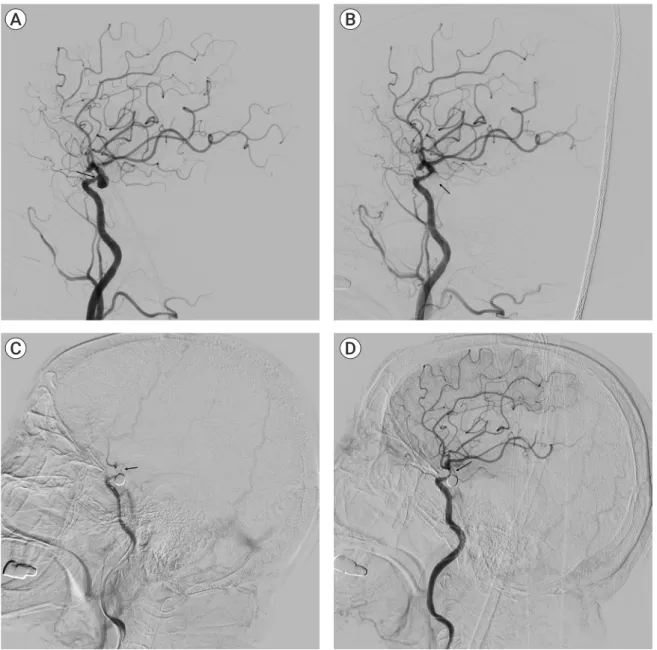 Fig. 1. (A) Preoperative left internal carotid artery angiogram showing left internal carotid artery aneurysm and mild stenosis  proximal to the aneurysm (arrow)