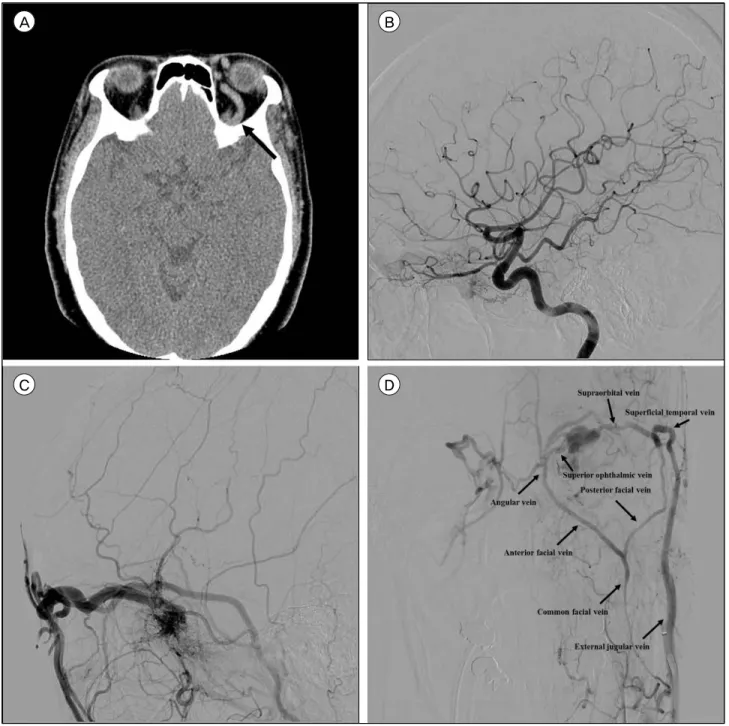Fig. 1. (A) Brain computed tomographic scan showing proptosis of the left eye ball and engorged left superior ophthalmic vein (ar- (ar-row)