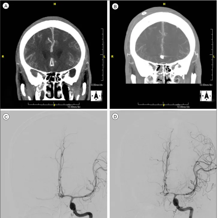 Fig. 2. (A) Both ACA are normal with no vasospasms shown in the initial CTA. (B) Both ACA showed severe vasospasms in the fol- fol-low-up CTA