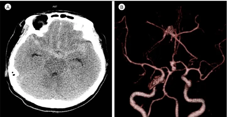 Fig. 1. A 50-year-old woman reported at the emergency department with thunderclap headache and vomiting