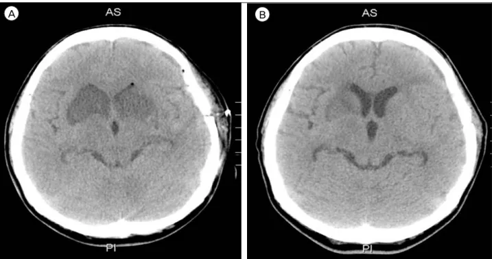 Fig. 4. (A) A 7-day postoperative follow-up brain computed tomography (CT) showed a newly developed low density lesion in the  recurrent artery of Heubner (RAH) territory bilaterally, caudate nucleus, anterior portion of basal ganglia, and internal capsule