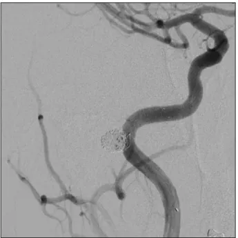 Fig. 3. Stent-assisted coil embolization was performed on the  petrous carotid aneurysm of the right ICA