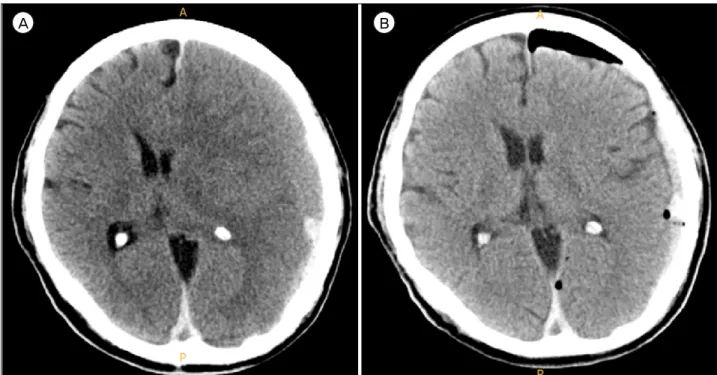 Fig. 1.  (A) Unenhanced computed tomography (CT) scan at the time of admission showed left-sided isodensity chronic subdural  hematoma