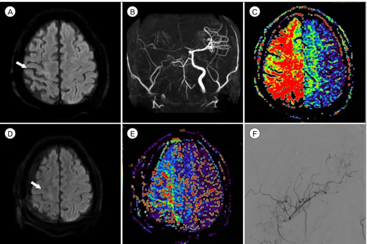 Fig. 1. (A) Initial diffusion-weighted imaging (DWI) revealed acute ischemic lesions (arrow) in the right hemisphere