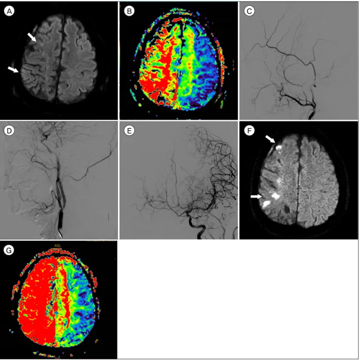 Fig. 2. (A) Diffusion-weighted imaging (DWI) showed recurrent acute ischemic lesions (arrows) in the right hemisphere six months  after the initial bypass surgery