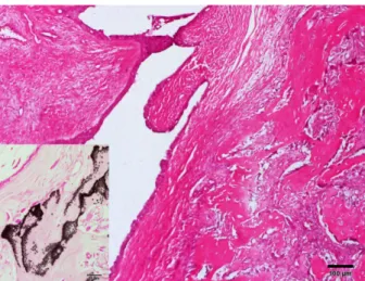 Fig. 4. Neoplastic foci are composed of acinar or tubular struc- struc-tures and islands of spindle cells (M) with mucinous materials in mammary gland complex adenoma (case 3)
