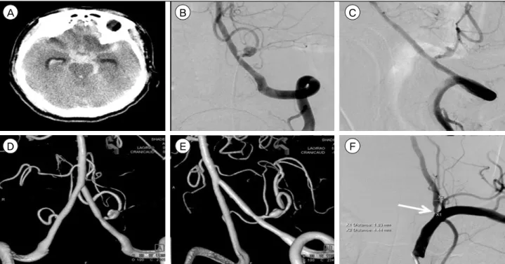 Fig. 1.  (A) The initial brain computed tomography scan shows acute subarachnoid hemorrhage on basal cistern with intraventricular  hemorrhage
