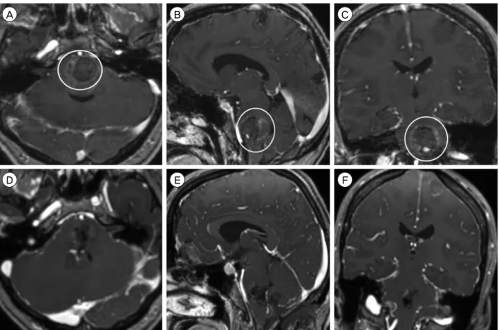Fig. 8. Preoperative MRI, T1-weighted sequence with contrast, (A) axial, (B) sagittal, and (C) coronal views, shows a 2.8 × 2.7 × 2.3  cm CCM in the left pons