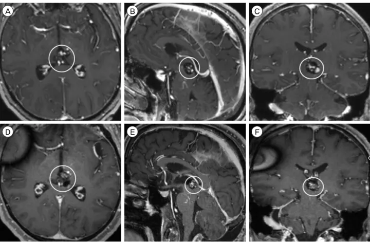 Fig. 2. Preoperative MRI, T1-weighted sequence with contrast, (A) axial, (B) sagittal, and (C) coronal views, shows a 1.7 × 1.5 × 1.7  cm CCM in left posterior medial thalamus and midbrain (circle)