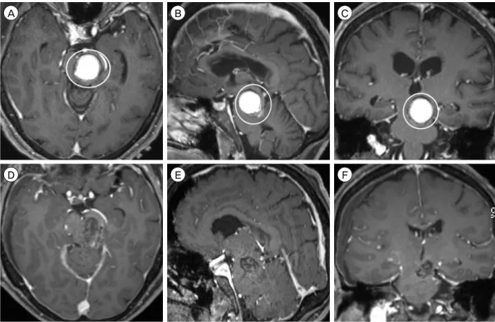 Fig. 3. Preoperative MRI, T1-weighted sequence with contrast, (A) axial, (B) sagittal, and (C) coronal views, shows a 2.1 × 1.9 × 1.9  cm CCM in the left midbrain, centered in the tegmentum (circle)