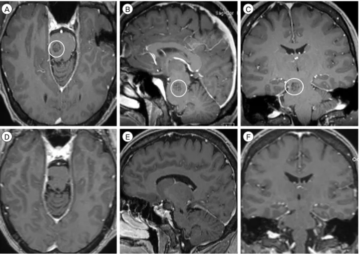 Fig. 4. Preoperative MRI, T1-weighted sequence with contrast, (A) axial, (B) sagittal, and (C) coronal views, shows a 1.0 × 1.0 × 1.1  cm CCM in the right pons, immediately inferior to the pontomesencephalic junction (circle)