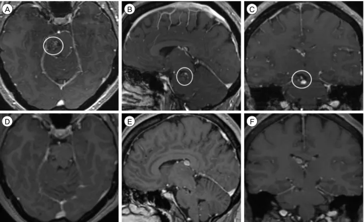 Fig. 5. Preoperative MRI, T1-weighted sequence with contrast, (A) axial, (B) sagittal, and (C) coronal views, shows a 1.4 × 1.2 × 1.3  cm CCM in the right midbrain and pons, centered at the pontomesencephalic junction (circle)