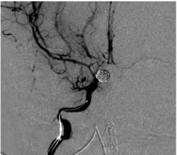 Fig. 3. Post-procedural angiography revealed dramatic improve- improve-ment as the proximal MCA M1 segimprove-ment diameters increased to  1.0 in the right and 1.2 mm in the left