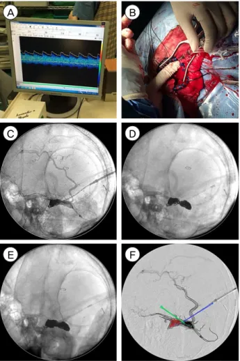 Fig. 3. Illustration of coil embolization under C-arm image guid- guid-ing after craniotomy