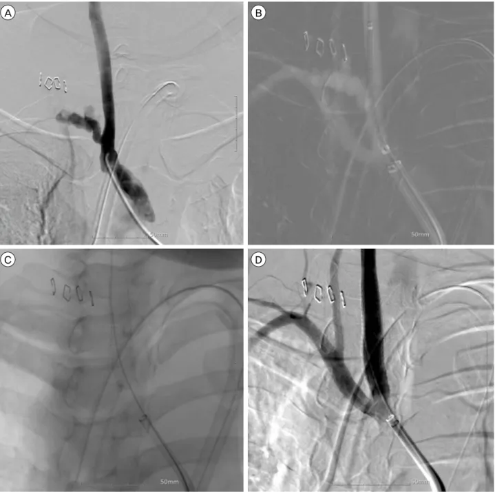 Fig. 1. Serial digital subtraction angiography (DSA) showing the stent deployment procedure
