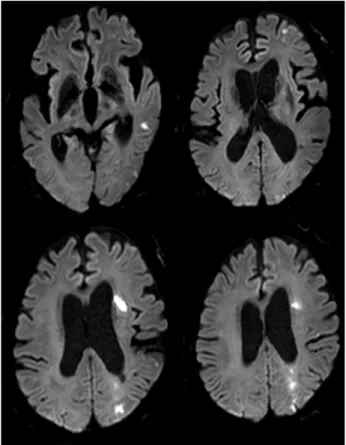 Fig. 3. MRI shows a new cerebral infarction at border zone of  left hemisphere. MRI = magnetic resonance imaging.