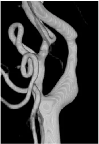 Fig. 5. Right CCA 3D angiogram shows mild stenosis of right  ICA. CCA = common carotid artery; ICA = internal carotid  artery.