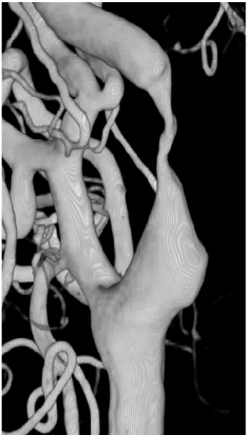 Fig. 8. Right CCA angiogram shows dilatation of ICA after  CAS. CCA = common carotid artery; ICA = internal carotid artery;