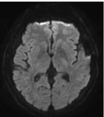 Fig. 4. Diffusion MRI scan at 25 days after the endovascular  treatment. The patient presented intermittent right hemiparesis,  but there was no acute lesion in the territory of left AChA