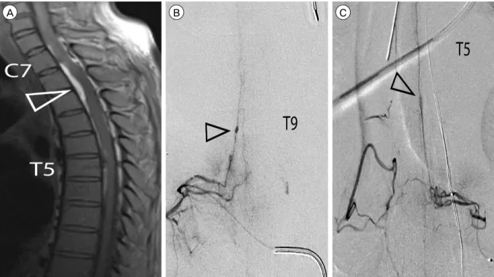 Fig. 1. Diagnostic imaging, 15 days (MR) and 16 days (Angiography) post-presentation. (A) Sagittal T1 MR with compressive hyper-in- hyper-in-tense ventral lesion at T2-level (open arrowhead) and axial extension from C7-T8