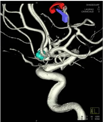 Fig. 2. Intra-operative angiography. A stent was placed around  aneurysmal neck and further coil was placed in aneurysmal sac.