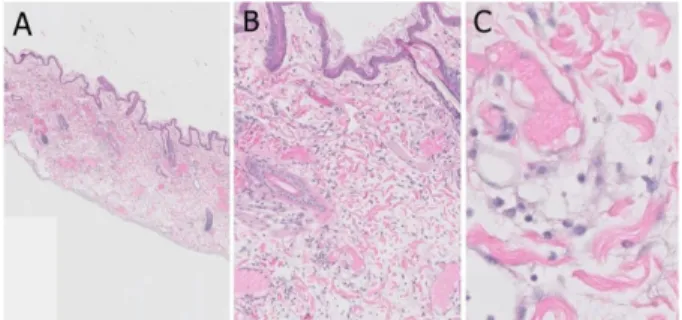 Fig. 3). Based on the diagnostic tests, the cat was diagnosed as EDS complicated with bacterial and fungal infection