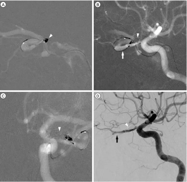 Fig. 3. Angiogram shows the first coil (white arrowhead) inserted into the fistula point of the ophthalmic sheath in lateral view (A)  and the fifth coil (white arrowhead) inserted into the shunting point via a transvenous approach
