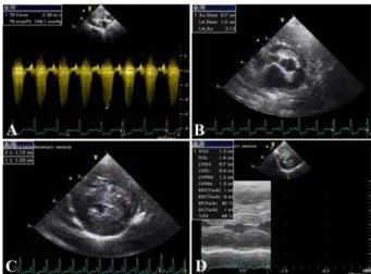 Fig. 2. Echocardiography of this case after 2 years of the first presentation. (A) Continuous wave Doppler study taken at right parasternal long axis of four chamber view found 5.20 m/s (pressure gradient 108.1 mmHg) systolic regurgitant jet flowing back t