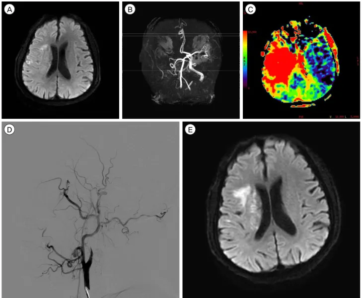 Fig. 1. (A) The initial diffusion-weighted image (DWI) reveals small acute infarcts in the cortex, subcortex and corona radiata of the  right hemisphere