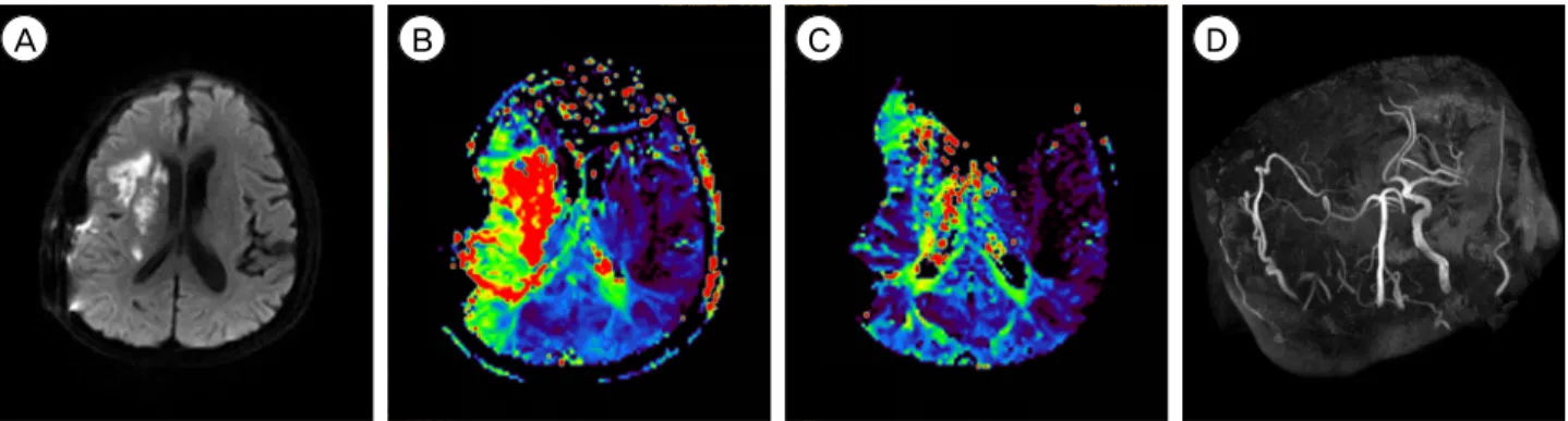 Fig. 2. (A) The diffusion-weighted image (DWI) on postoperative day 7 reveals a slight increase in cerebral infarction
