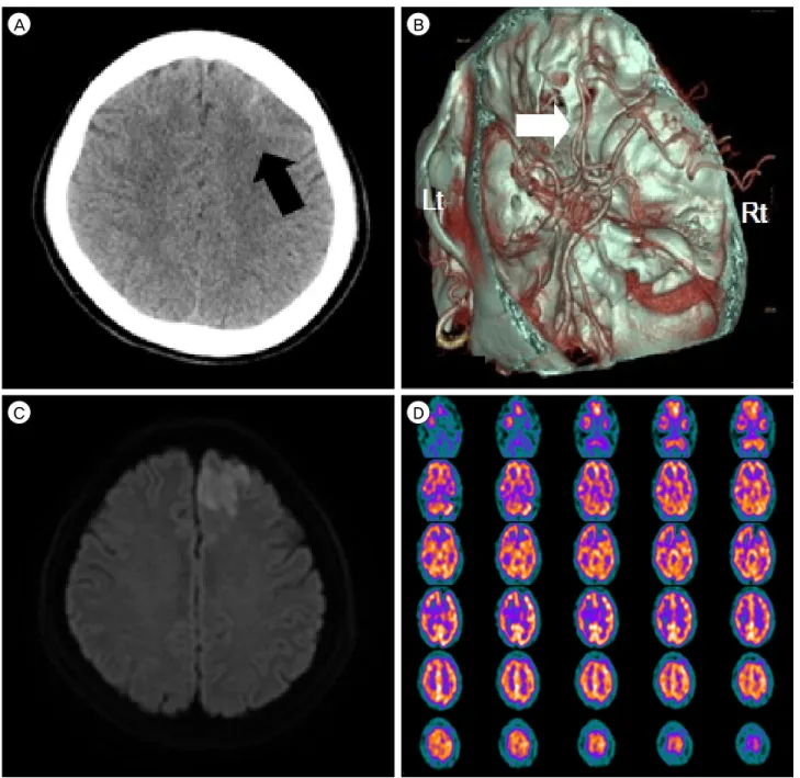 Fig. 1. (A) Computed tomography scan of the patient showing subarachnoid hemorrhage (black arrow) on left frontal convexity