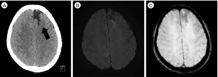 Fig. 2. (A)  Computed  tomography  shows  that  low  intensity  of  previous  ACA  infarction  territory  (black  arrow)  and  no  high  intensity  presenting SAH on left frontal convexity