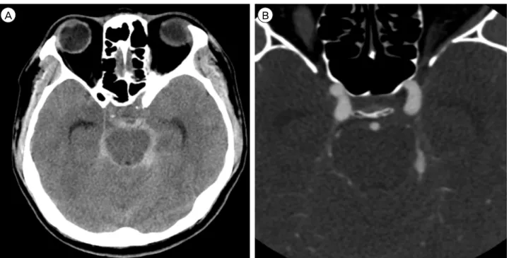 Fig. 1. (A) Brain computed tomography (CT) image. The brain CT shows a Fisher Grade III SAH in the pre-pontine, left ambient and  quadrigeminal cistern