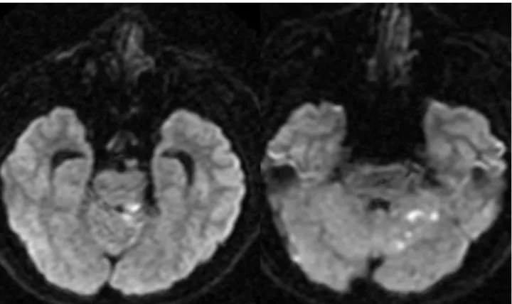 Fig. 4. Diffusion weighted images (DWIs) 1 day post-treatment. The DWIs show scattered high signal change, suggesting acute in- in-farction on the left posterior tegmentum, superior vermis, and superior part of the left cerebellum.