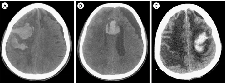 Fig. 1. CT scans of the three hemorrhages. (A) the first hemorrhage in the right frontal cortex