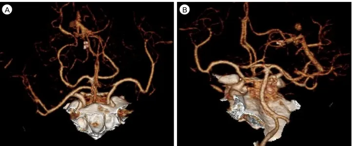 Fig. 2. Brain CT angiography revealed no specific lesions of vascular origin (A, B). CT = computed tomography.