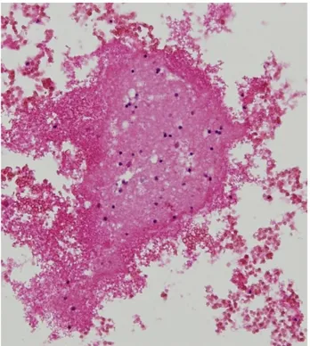 Fig. 3. Fragmented brain tissue with hemorrhage (× 200). No  other interesting outcomes were discovered.