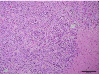 Fig. 4. The neoplastic cells show diffuse expression of vimentin. IHC stain. Scale bar = 100 µm.