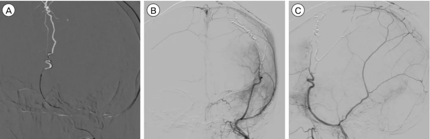Fig. 4. After six days from second admission, Onyx embolization was performed. (A) Superselected left MMA with microcatheter and  double  micro-guidewire