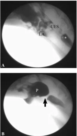 Fig. 1. Digitally captured video fluoroscopic images are shown from the patient. (A) This image is taken when iohexol contrast medium was injected with syringe into the mouth