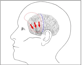Fig. 1. The illustration depicts the course of fibers of the tempo- tempo-ralis muscle and the direction of displacement, or sliding, (red  arrows) of unattached temporalis muscle after pterional  craniot-omy (PC)
