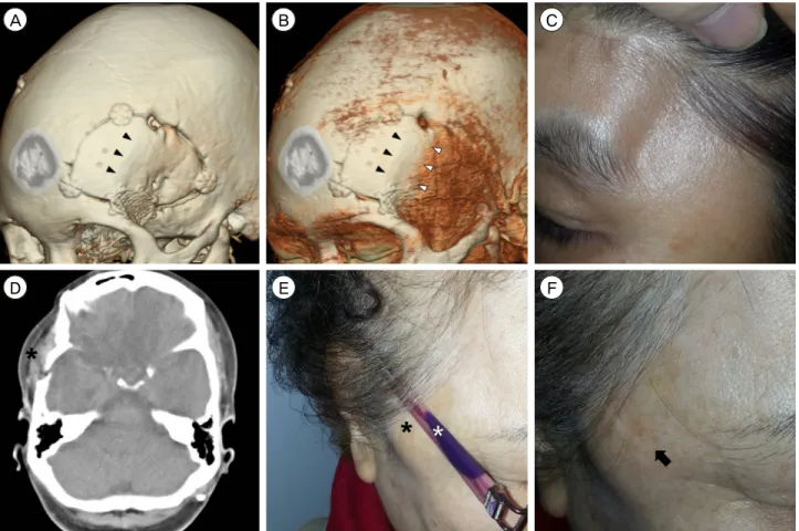 Fig. 2. Three-dimensional computed tomography (CT) scans (A, B) of a patient demonstrate the temporal line of the frontal bone  (black arrowheads) and the displaced attachment site of the temporalis muscle (white arrowheads)