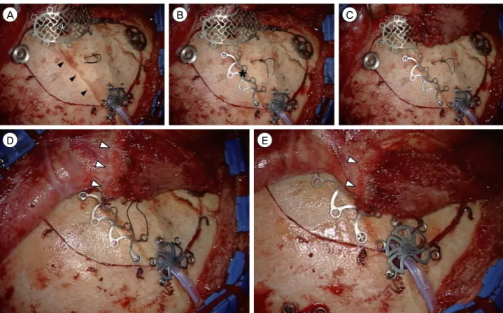 Fig. 4. Intraoperative photographs demonstrate the technique for reconstruction of the temporalis muscle using a contourable strut  plate (CSP)