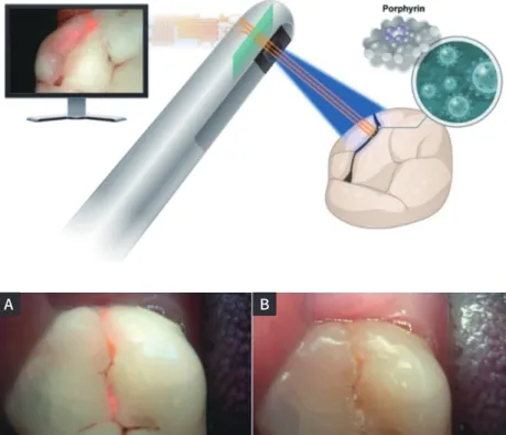 Fig. 2. Example of quantitative light-induced  fluorescence images using Q-ray pen. (A)  Flurorescent image of cracked tooth (test  side), (B) Normal image of cracked tooth  (contralateral site).