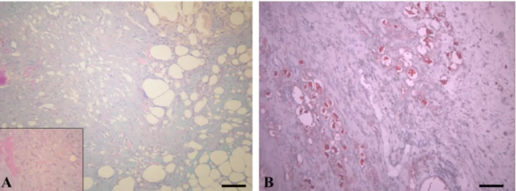 Fig. 2. Myxoid liposarcoma, dog. (A) Acidic mucin, neutral mucin, and mixture of acidic and neutral mucin are expressed blue, magenta or bluish purple (Box: high magnification of A)