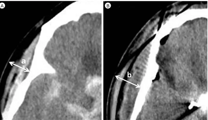 Fig. 1. Thickness of myocutaneous layer (in mm) from the surface of the skull to that of the scalp on the  pterional craniotomy site  at  or  just  above  the  level  of  zygomatic  arch  on  the  head  CT  slice