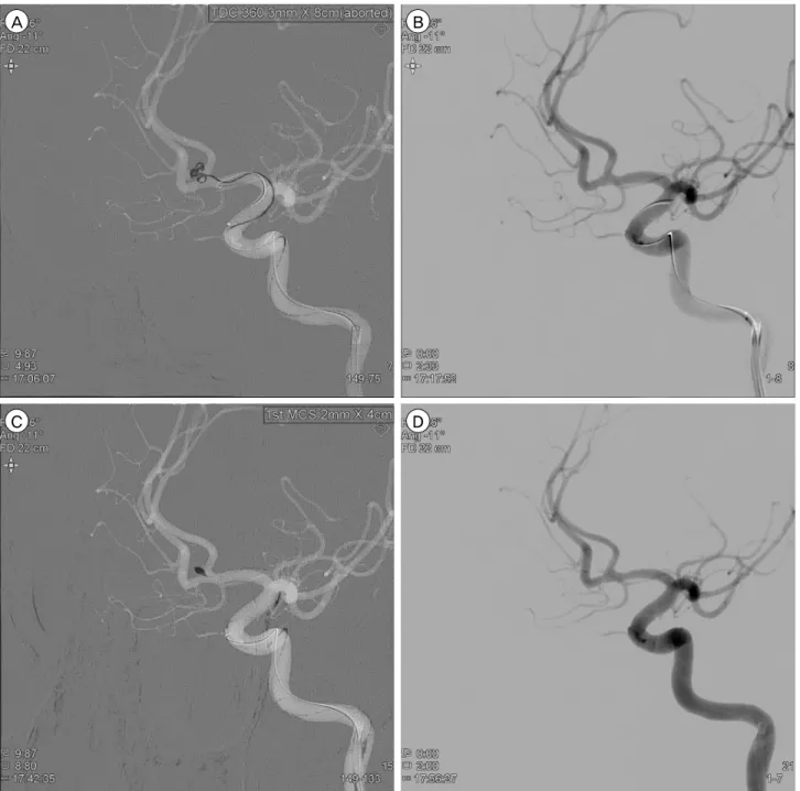 Fig. 3. Neurointerventional images during coil embolization. At the moment of deploying the first coil, the tip of the microcatheter is  seen to move back from the aneurysm and the projection of the coil loop outside the aneurysm is observed (A)